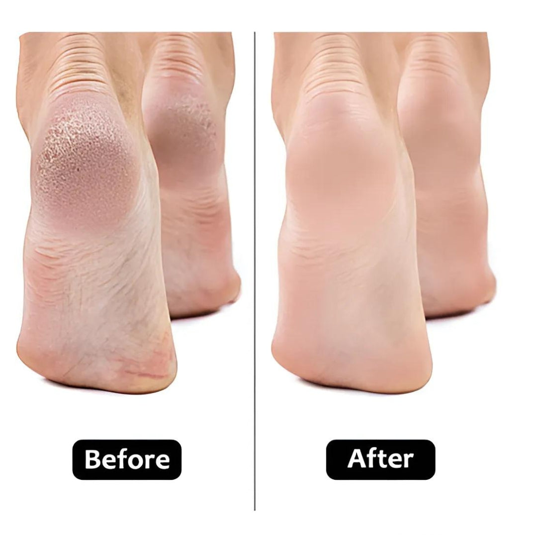 Electric Foot Callus Remover